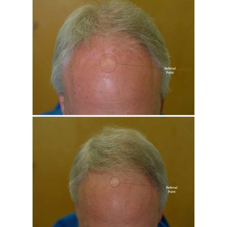 Bande laser Hairmax 82