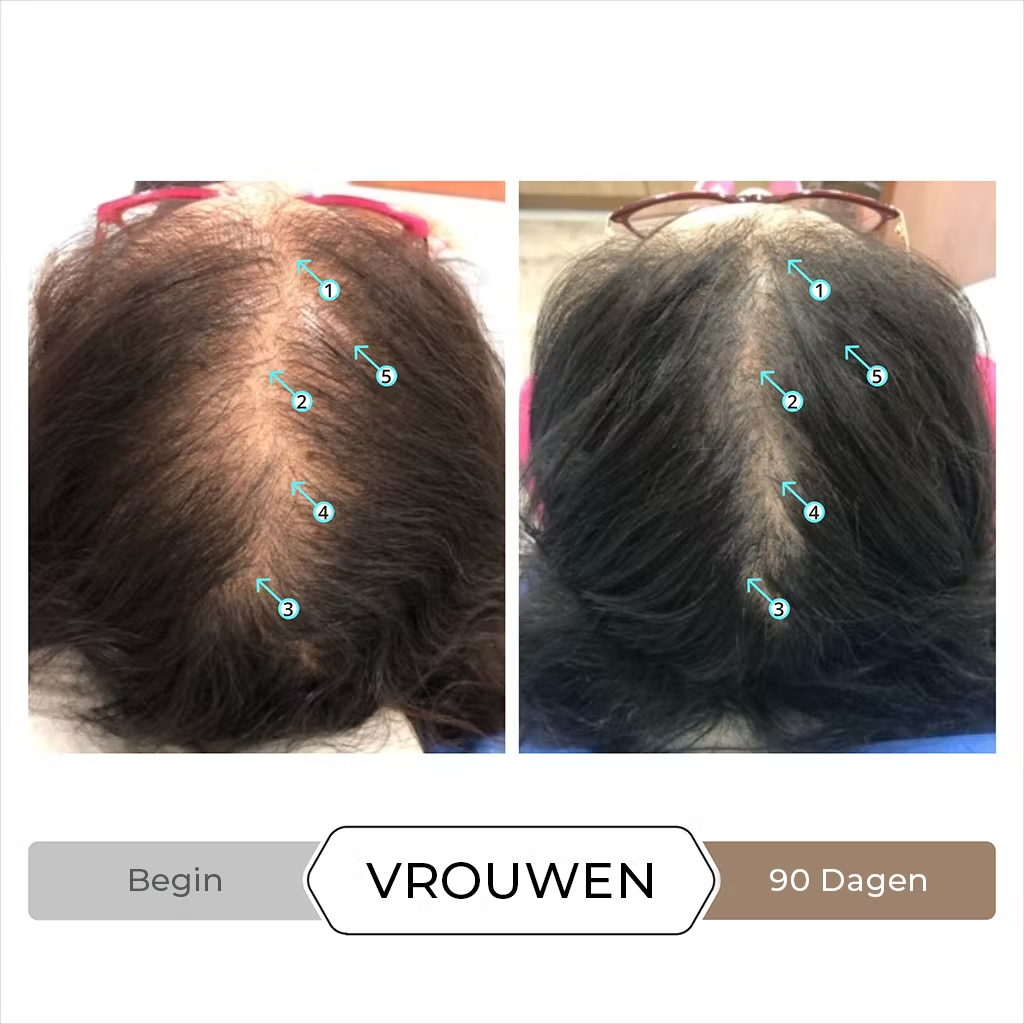 Spectral.DNC-N Traitement Anti-Chute avec 5% de Nanoxidil - 60 ml
