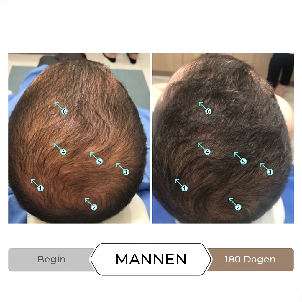 Spectral.DNC-N Traitement Anti-Chute avec 5% de Nanoxidil - 60 ml