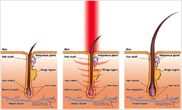 laser haar