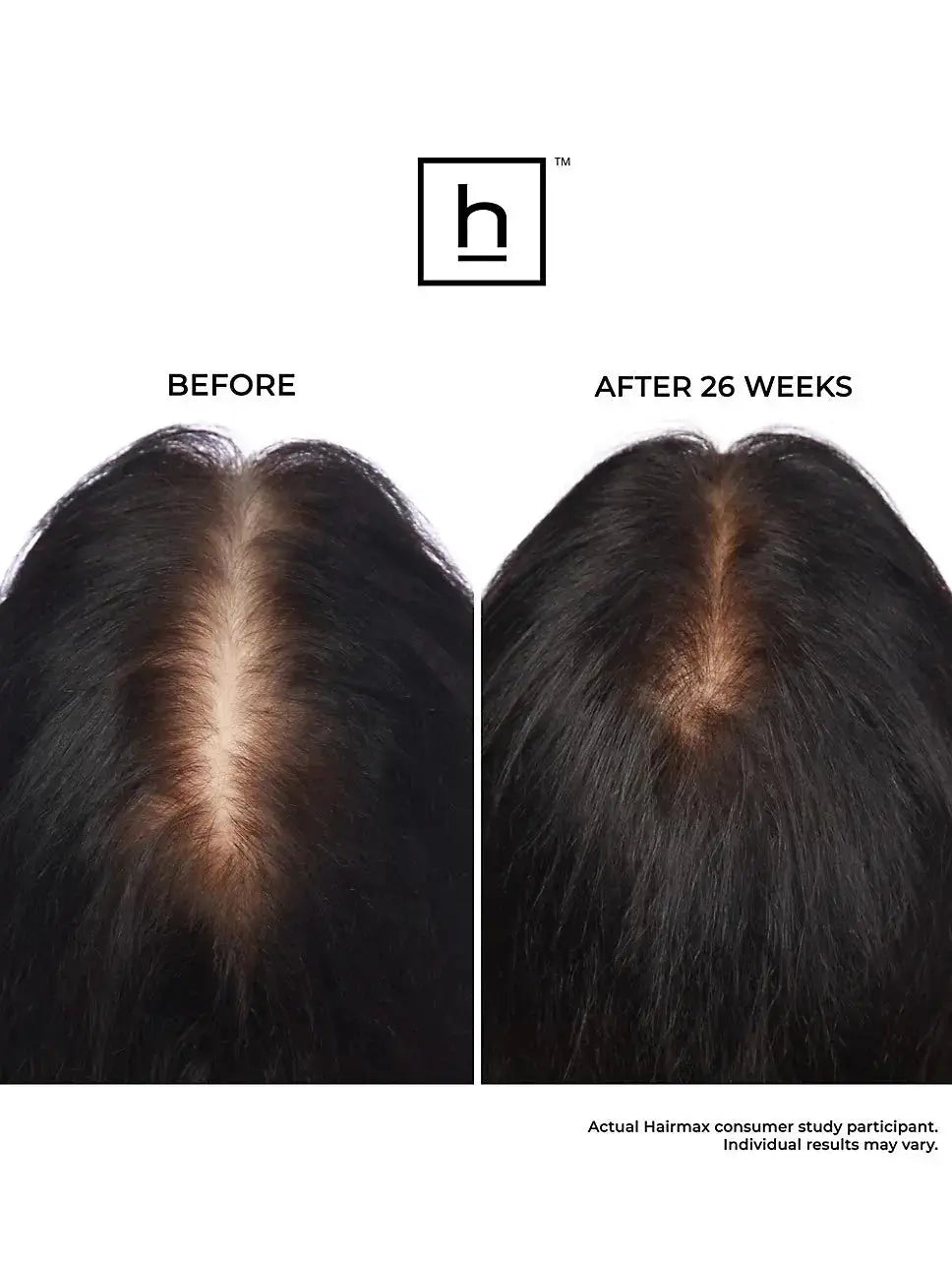 Bande laser Hairmax 82 