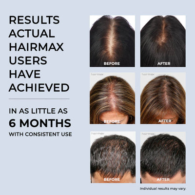 Hairmax LaserBand 41 Comfort Flex