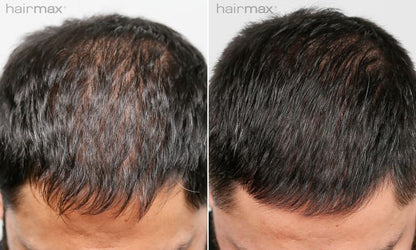 Hairmax Laserkam Ultima 12 Classic