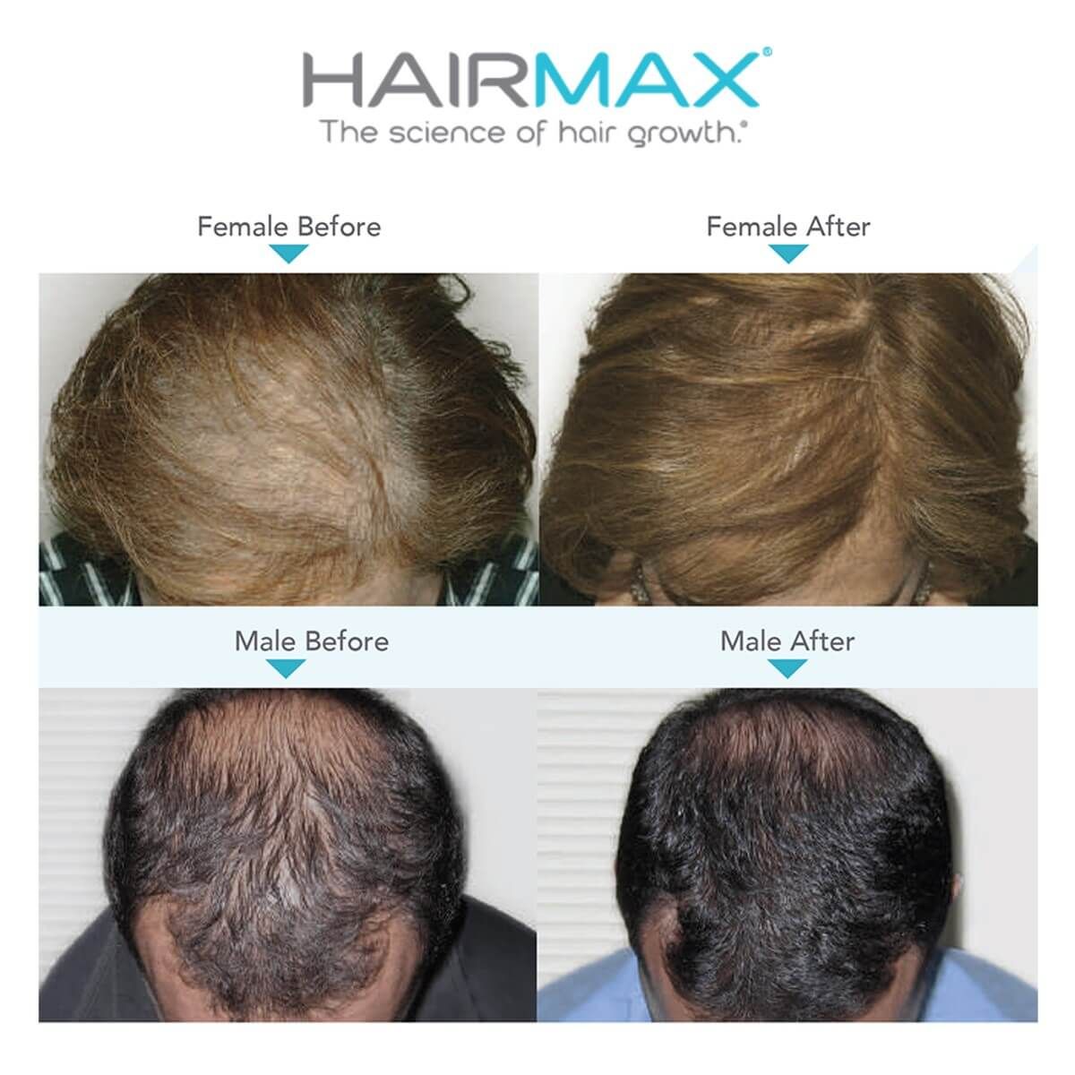 Bande laser Hairmax 82 